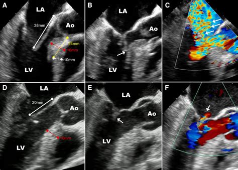 How To Image Hypertrophic Cardiomyopathy Circulation Cardiovascular