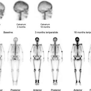 Mtc Mdp Anterior And Posterior Whole Body Bone Scans And Right