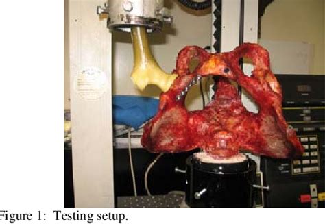 Figure 1 From Biomechanical Comparison Of Trans Sacral And Triangular