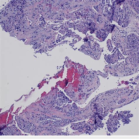 Hematoxylin And Eosin Hande Stain Of The Specimen From A Ct Guided Core