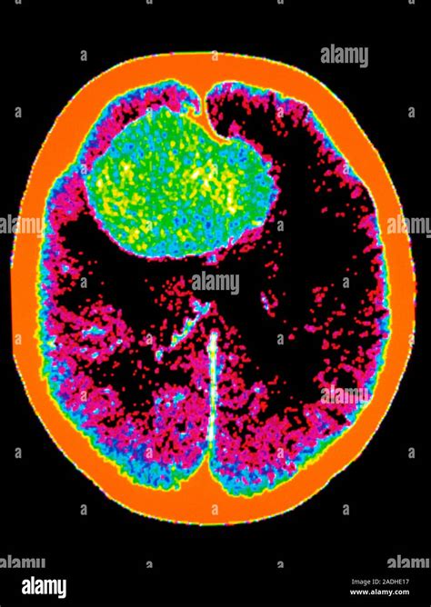 La Hemorragia Cerebral Coloreado De Tomografía Computarizada Ct