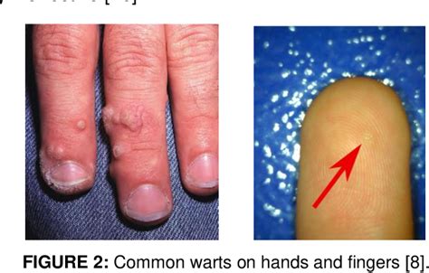 PDF Generation Of Skin Diseases Into Synthetic Fingerprints