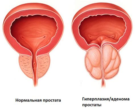 Аденома простаты Евромед