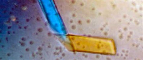 Cuerpos Cetónicos En La Orina Qué Significa La Guía De Las Vitaminas