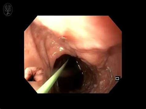 Dilatation Pneumatique Pour Achalasie Chez Un Patient Pr Sentant Des