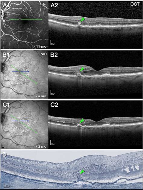 Cystoid Macular Edema Histology