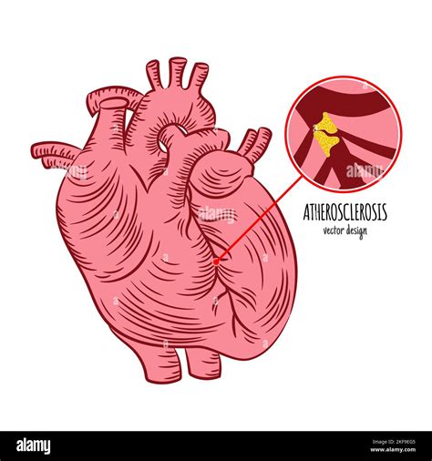 Atherosclerosis Chronic Disease Medicine Education Diagram Vector