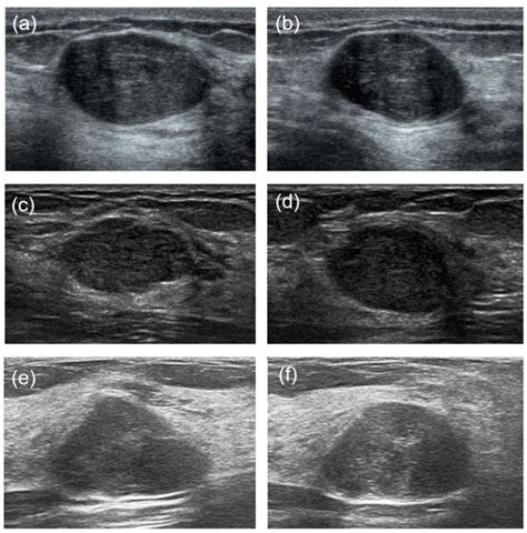 Sensors Free Full Text Differentiation Between Phyllodes Tumors And