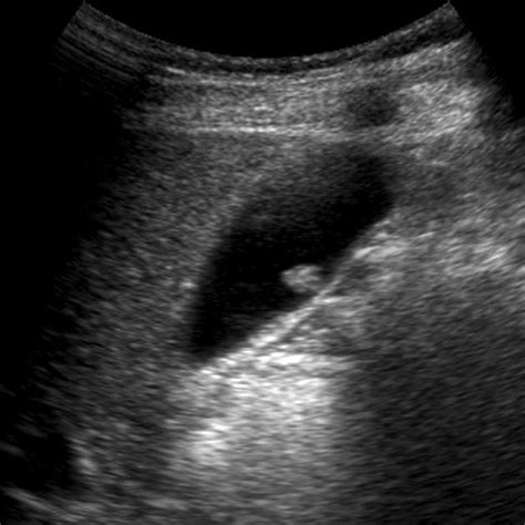 Gallbladder Polyps Ultrasound