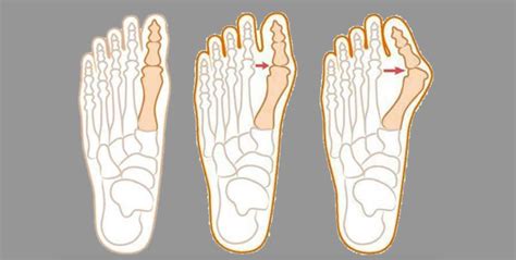 Hallux Valgus Et Course à Pied Que Faire Esprit Trail