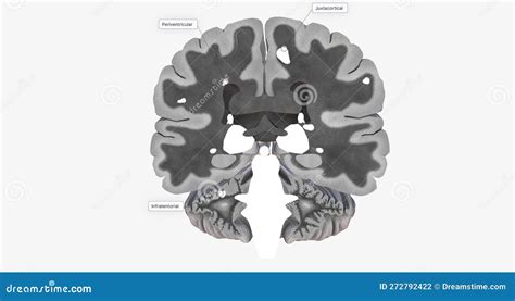 The Brain With Lesions MRI Stock Photography | CartoonDealer.com #272791022