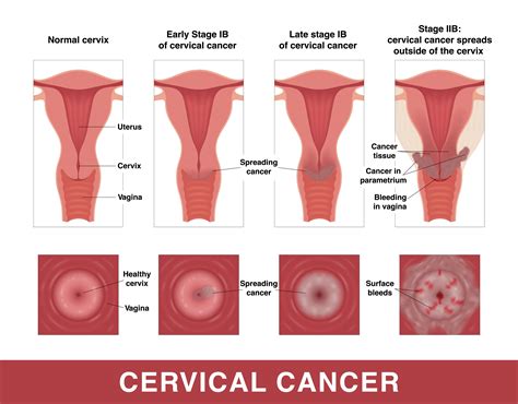High Vs Low Cervix