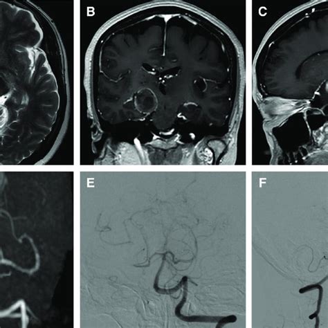 A Axial T2 Weighted Magnetic Resonance Imaging Mri On Admission