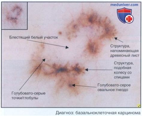 Диагностическая дерматоскопия - алгоритм, этапы