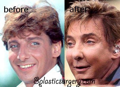 Barry Manilow Plastic Surgery