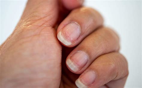 Síndrome das unhas frágeis o que causa e como tratar o enfraquecimento