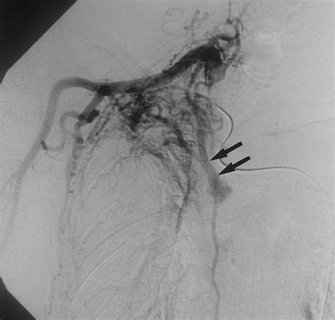 Bronchial And Nonbronchial Systemic Artery Embolization For Life