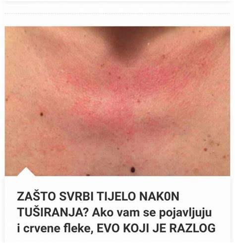 Za To Me Tijelo Svrbi Nakon Tu Iranja Ako I Vi Imate Crvene Mrlje Evo