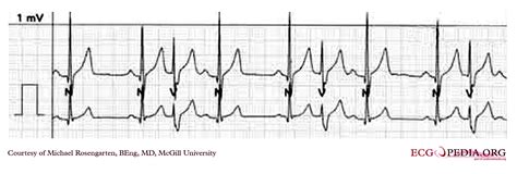 Premature Ventricular Contraction EKG Examples Wikidoc