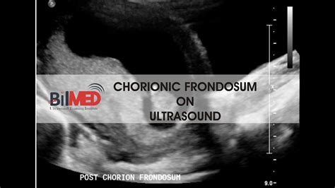 CHORIONIC FRONDOSUM ON ULTRASOUND | Vlogs | BilMed USG Training - YouTube