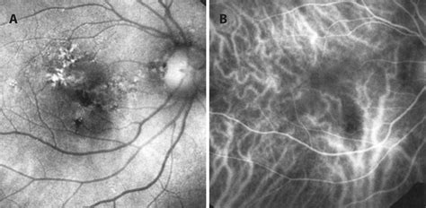 Scielo Brasil Grid Laser Photocoagulation In The Treatment Of