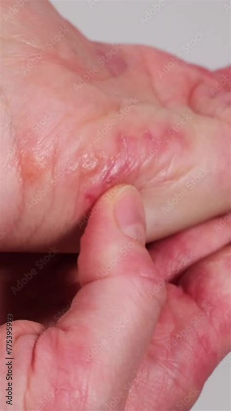 Woman Scratching Her Cracked Dry Skin Of Palm Red Stains On Female