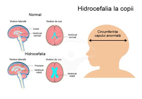 Hidrocefalia Cauze Simptome Si Tratament Hot Sex Picture Hot Sex Picture