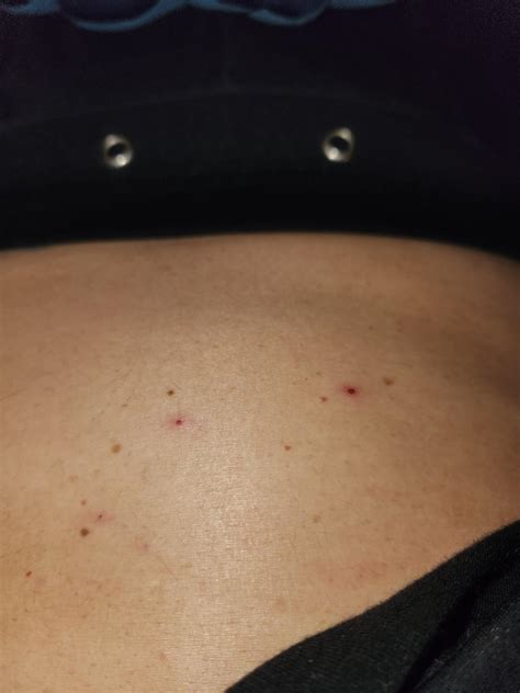 I Have Tiny Red Bumps On My Stomach They Itch Sometimes And When I Scratch They Bleed Any