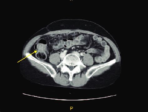 Contrast Enhanced Ct Image Shows Omental Infiltration Peritoneal Download Scientific Diagram