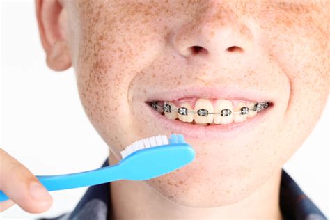 Gingivitis And Swollen Gums In Teens With Braces Thomas Orthodontics