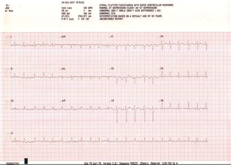 how to get an ekg