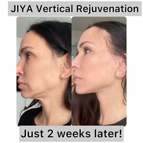 Best Facelift With Necklift In Raleigh Nc Dr Jindal