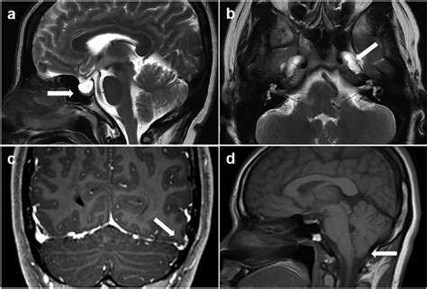 Classical Magnetic Resonance Imaging Mri Signs Suggestive Of Elevated