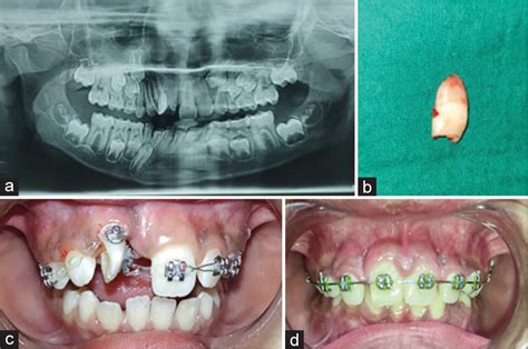 Orthodontic Management Of Midline Diastema Caused By Mesiodens A Case