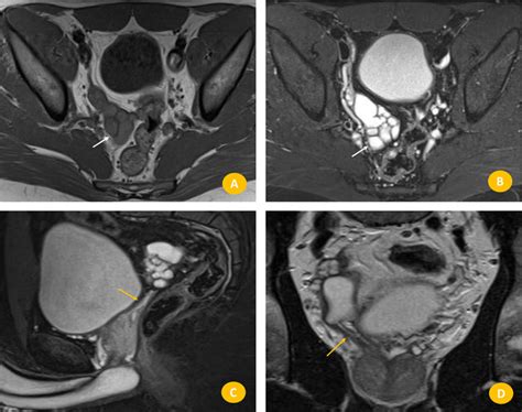 Pelvic Mri A And B Axial T1 And T2 Weighted Mri Image Showing