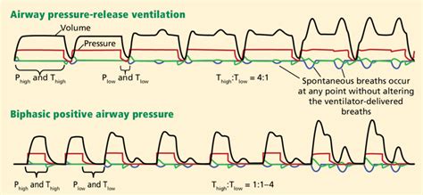 Airway Pressure Release Ventilation Top And Biphasic Positive Airway