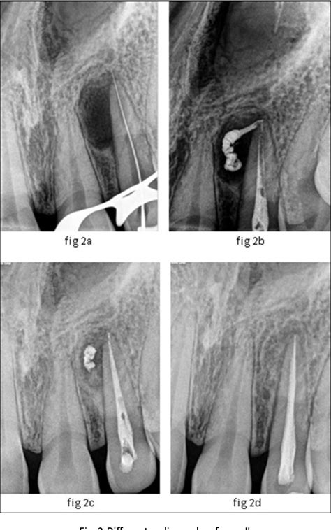 Figure 2 From Accelerated Non Surgical Healing Of Large Periapical