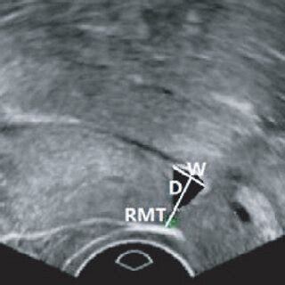 Shapes Of The Cesarean Section Diverticulum A Triangle Shape B