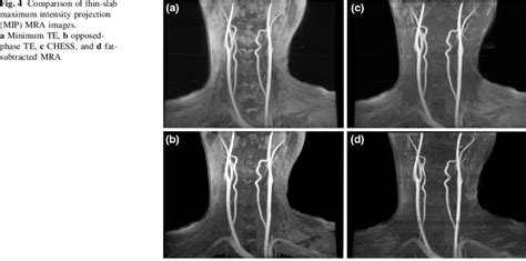 Comparison Of Thin Slab Maximum Intensity Projection Mip Mra Images