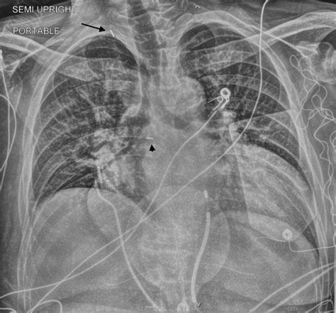 Intra Aortic Balloon Pump Xray