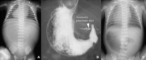 Frontiers Case Report Laparoscopic Gastrojejunostomy For Duodenal