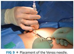 Laparoscopic Cholecystectomy Basicmedical Key