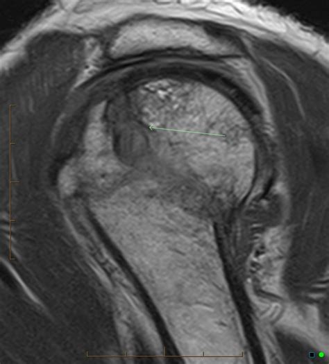 Intraosseous Course Of Biceps Tendon Post Humeral Fracture Image