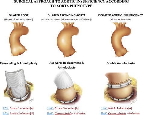 Isolated Bicuspid Aortic Valve Repair With Double Annuloplasty How I