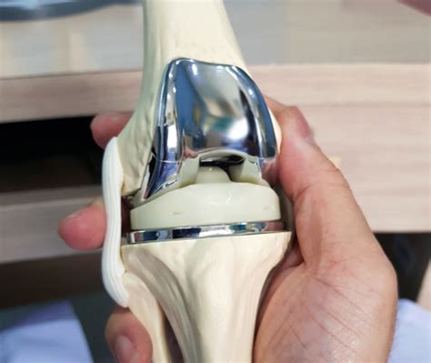 Knee Replacement Surgery Dr Lokesh Dabral Orthopedic And Joint