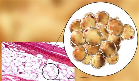 Fat Necrosis Complication Of Cosmetic Fat Transfer Psh