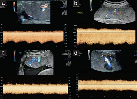 Doppler Evaluation Of Normal And Abnormal Placenta Hernandez‐andrade