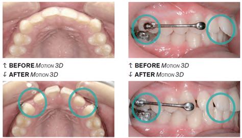 Motion 3d™ Class Ii Appliance Henry Schein® Orthodontics