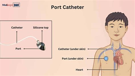 Port Catheter Lawsuit Updates 2025: Check Out!