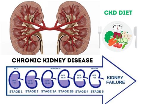 CKD DIET :Guide To Managing Chronic Kidney Disease Naturally